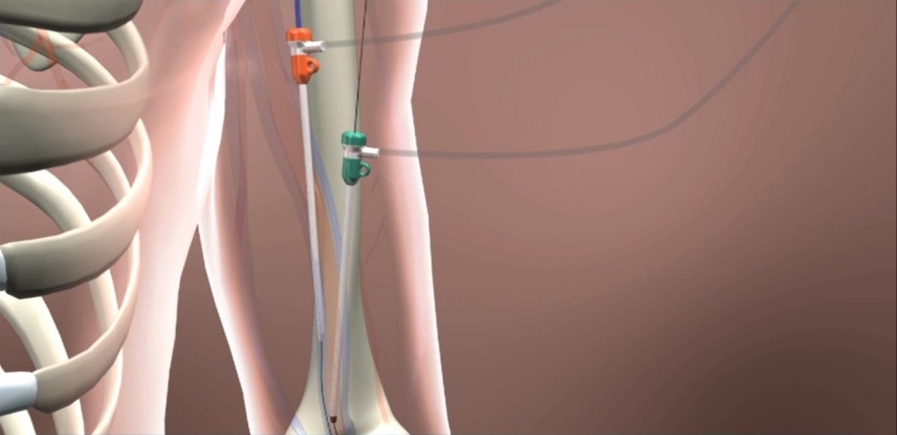 WavelinQ EndoAVF dialysis access