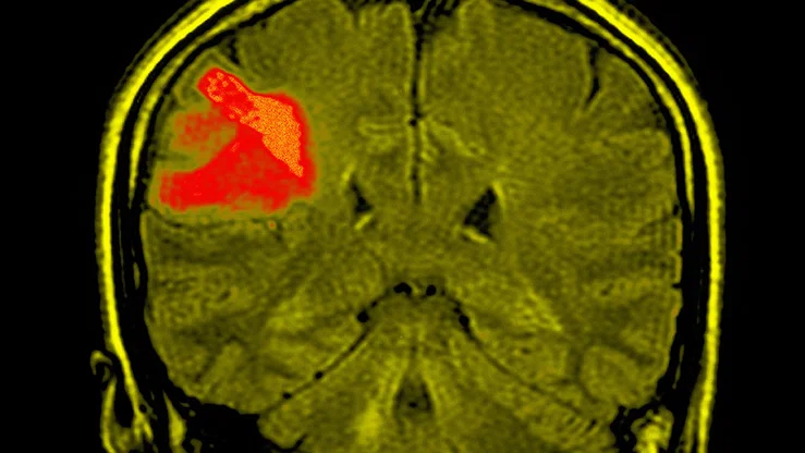 glioblastoma_brain.jpg