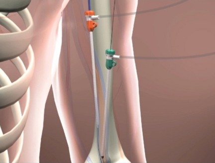 WavelinQ EndoAVF dialysis access